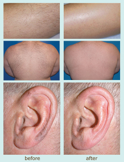 Laser Hair Removal before and after photo