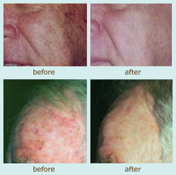 Photodynamic Therapy before and after photo