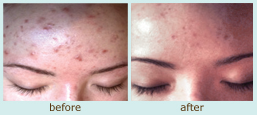 Pore Clarifying Treatment image