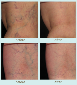 Sclerotherapy image