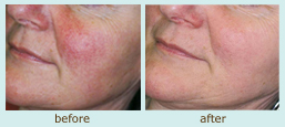 Vascular Laser Therapy before and after photo